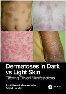 Dermatoses in Dark Vs Light Skin: Differing Clinical Manifestations - Click Image to Close