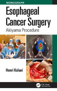 Esophageal Cancer Surgery: Akiyama Procedure