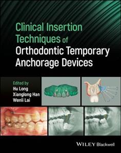 Clinical Insertion Techniques of Orthodontic Temporary Anchorage Devices - Click Image to Close