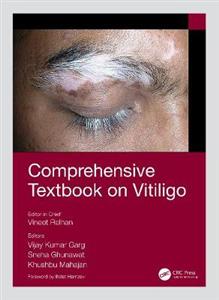 Comprehensive Textbook on Vitiligo - Click Image to Close