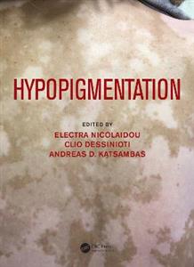 Hypopigmentation - Click Image to Close