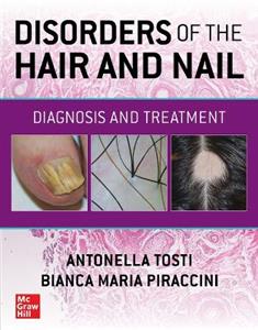 Disorders of the Hair and Nail: Diagnosis and Treatment - Click Image to Close