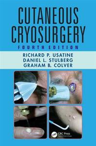 Cutaneous Cryosurgery - Click Image to Close