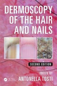 Dermoscopy of the Hair and Nails - Click Image to Close