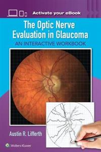 The Optic Nerve Evaluation in Glaucoma - Click Image to Close