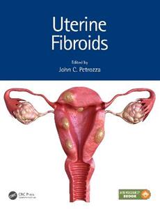 Uterine Fibroids - Click Image to Close