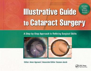 Illustrative Guide to Cataract Surgery - Click Image to Close