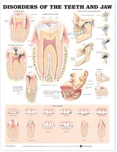 Disorders of the Teeth and Jaw Anatomical Chart