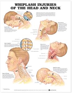 Whiplash Injuries of the Head and Neck Anatomical Chart