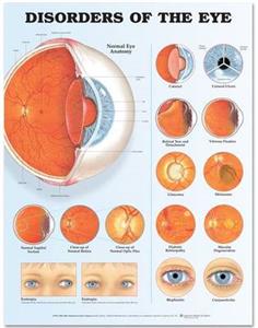 Disorders of the Eye Anatomical Chart