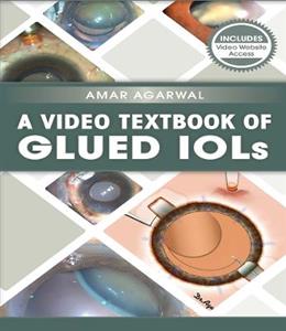 A Video Textbook of Glued IOLs - Click Image to Close