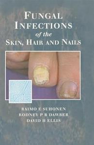 Fungal Infections of the Skin and Nails - Click Image to Close