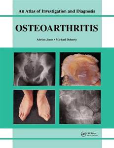 Oesteoarthritis - Click Image to Close