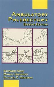 Ambulatory Phlebectomy