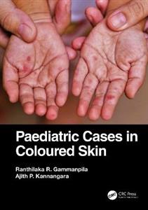 Paediatric Cases in Coloured Skin