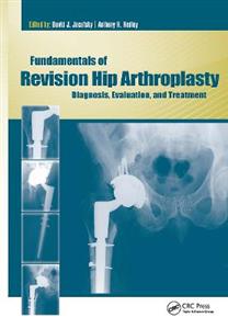 Fundamentals of Revision Hip Arthroplasty