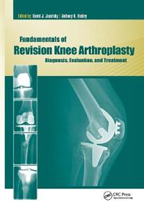 Fundamentals of Revision Knee Arthroplasty