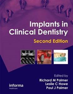 Implants in Clinical Dentistry